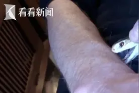 是个狠人！男子注射蛇毒18年，产生抗体……此前已截掉部分手指图片