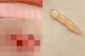 海量财经丨取暖贴也能伤人？不少人使用不当被低温烫伤图片