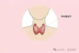 甲状腺结节，不是儿戏！图片