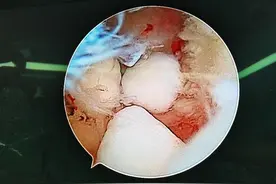 总是腿打软？小心关节腔里有游离体作怪！医生建议尽早手术治疗图片