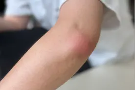 这种体质的人被蚊子咬了，“ 蚊子包 ”又大又红！图片