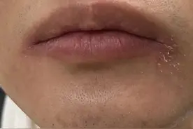 近期上海此类患者增多！有人被反复折磨：从崩溃到摆烂！根本没法见人……图片