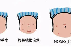 只打几个“小洞”免去二次手术 四川省人民医院为直肠癌患者“极致”微创手术图片