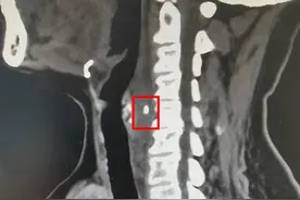 鱼刺卡喉她用了土办法，殊不知鱼刺正悄悄向颈总动脉逼近……图片