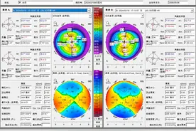 眼角膜太薄，摘镜遇“困境”？专家解惑：还有别的选择图片