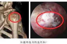 肩膀痛，可能是钙化性肌腱炎惹的祸！图片