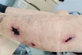 小心！筋膜枪打出小腿溃疡！这几个部位，绝对不要使用……图片