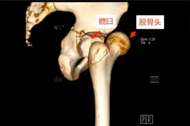 长沙一女童荡秋千致髋关节脱位！户外活动正当时，骨科接诊小患者增多图片