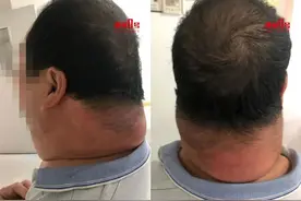 脖子肿得比头粗！柳州男子患上罕见病，只因30年来的这个习惯图片