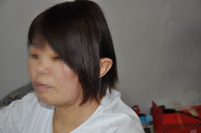 女子左耳寄養(yǎng)在腳背5個(gè)月成功回家 奇跡般的重生