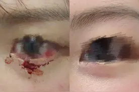 猫爪伤眼险毁容！医生：被动物咬伤，尽早就医很关键图片