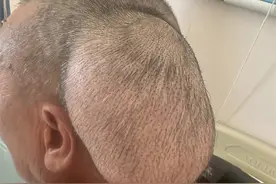 莫忽视头部小包块 云南这名患者鼓包六十年恶变成“癌”图片