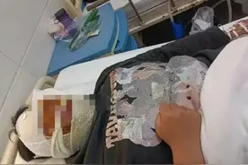 吸睛表演意外多！13岁男孩面部被烧伤！图片