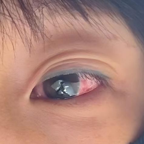 粉色“子弹”飞过来，我的左眼什么都看不清了