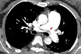 【朝医新闻】多学科联合救治一例急性中高危骑跨型肺栓塞高龄孕妇图片