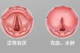 近期高发的嗓子疼，可能隐藏着一种“凶险”急症！图片