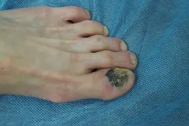 皮肤长这些“怪东西”，就是皮肤癌！医生教你如何辨别图片