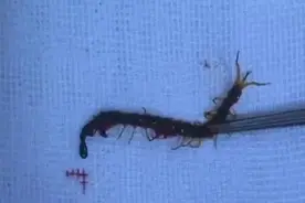 13岁男孩睡梦中疼醒，耳朵里竟藏有一条活蜈蚣……图片