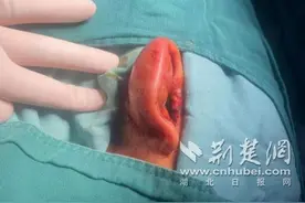 16岁女孩软骨上打耳洞 引发软骨膜炎导致耳廓畸形图片