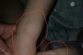 亲吻导致？山西一母亲吐槽3岁幼儿疑遭幼儿园老师啃咬后留下牙印，多部门介入图片
