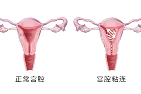 超声小课堂 | 女性宫腔粘连，超声检查这样诊断图片