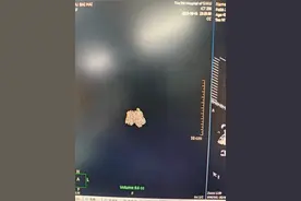 两眼一黑竟是脑干出血！机器人辅助在“生命禁区”精准操作图片