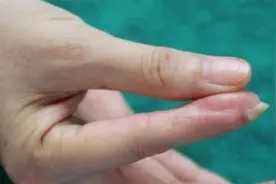 六年蚀骨之痛终得解，创新皮瓣手术保全指图片