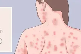 “梅”那么可怕——带您正确认识梅毒图片