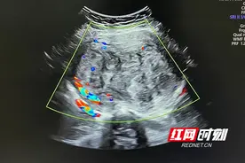 长沙普瑞医院专家巧手“拆弹” 微创切除12cm巨型子宫肌瘤图片