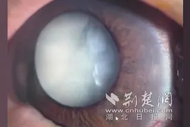 双重眼疾致七旬老人“雾里看花”多学科协作打开清晰视界图片