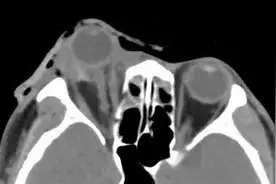 男子酒后摔倒，把眼球“摔出来了”！喝酒后千万别做四件事图片