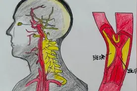 藏在脖子里的“不定时炸弹”，你排查了吗？图片