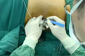 闸中心开展这项技术，解除患者长期顽痛图片