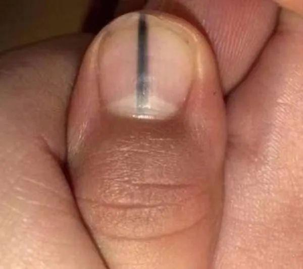 指甲出现这个变化可能是癌变