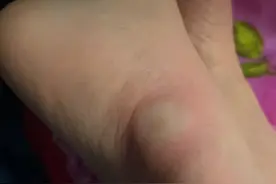 男童被虫咬后脚肿得穿不上鞋，“暂不排除骨髓炎”！蚊虫活跃期应注意这些图片
