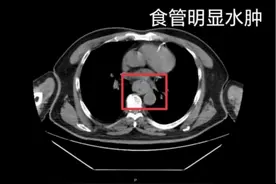 一口“热辣滚烫”男子吐血休克 “趁热吃”可能致癌图片