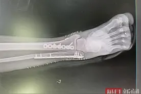 女子崴脚后按摩数日无好转，就医后才发现已骨折！图片