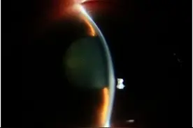 西安交通大学第二附属医院成功实施陕西省首例微创小梁切除术图片