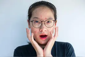 哪些因素是“青春痘”催化剂？皮肤科专家教你这样科学战“痘”图片
