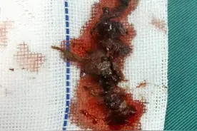 人体这个部位也能“发霉”！63岁老太中招入院，医生提醒雨季需注意这些图片