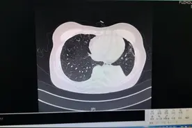 女子在家整理衣服，突然高烧40℃，肺部“长满”霉斑！元凶家家都有图片