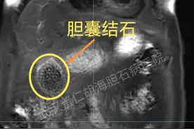 三餐不定常吃剩菜，八旬奶奶胆囊化脓，医生手术取出590颗结石图片
