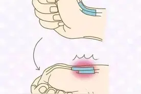 手腕疼 当心腱鞘炎图片