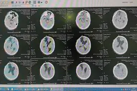 滕州市中心人民医院成功完成一例颅骨缺损修补手术图片