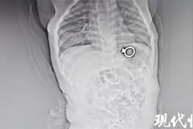 11月龄的宝宝误吞直径2厘米钻戒，医生2分钟取出图片