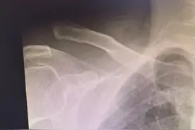 微创技术 新发展丨4个不到1cm的小切口治愈肩锁关节脱位图片