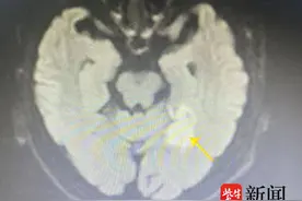 走路像“踩棉花”，70岁大爷小脑梗死图片