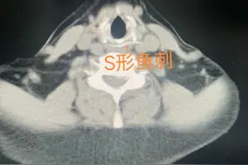浙江女子被鱼刺卡喉，又是吞饭团又是喝醋，结果悲剧了图片