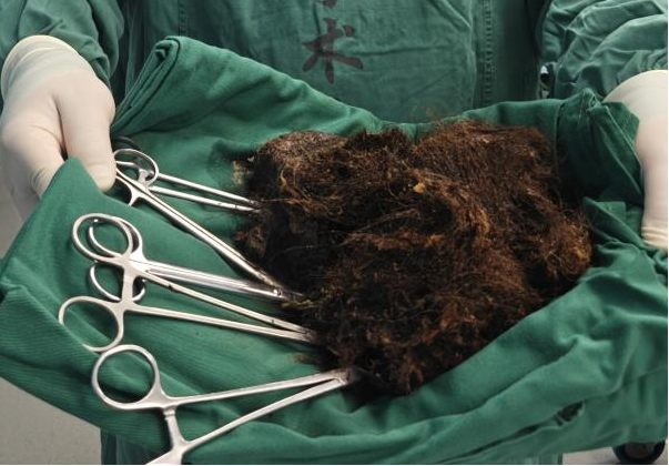 发现1例，25岁女子确诊！胃里取出2斤，密密麻麻！有人因羞耻延误就医