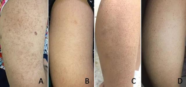 别抠了！这些小颗粒真不是痘痘，也别随便用药！